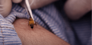 apiterapija - lecenje pcelinjim otrovom